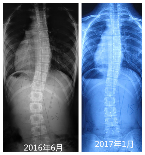 张佳朋 X线片_副本.jpg